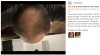 Kirkland Minoxidil 5% nuo plaukų slinkimo - 6 mėn. plaukų atauginimo kursas 