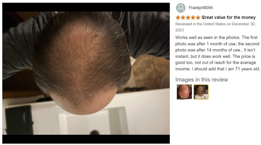 Kirkland Minoxidil 5% nuo plaukų slinkimo - 6 mėn. plaukų atauginimo kursas 