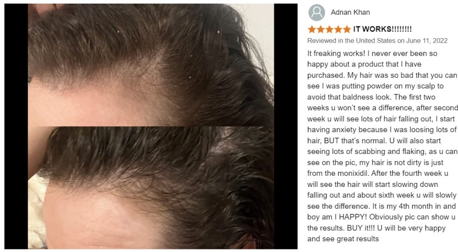 Kirkland Minoxidil 5% nuo plaukų slinkimo - 6 mėn. plaukų atauginimo kursas 