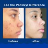 PanOxyl® putojantis prausiklis nuo aknės - benzoilo peroksidas 10 %