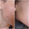 PanOxyl® putojantis prausiklis nuo aknės - benzoilo peroksidas 10 %