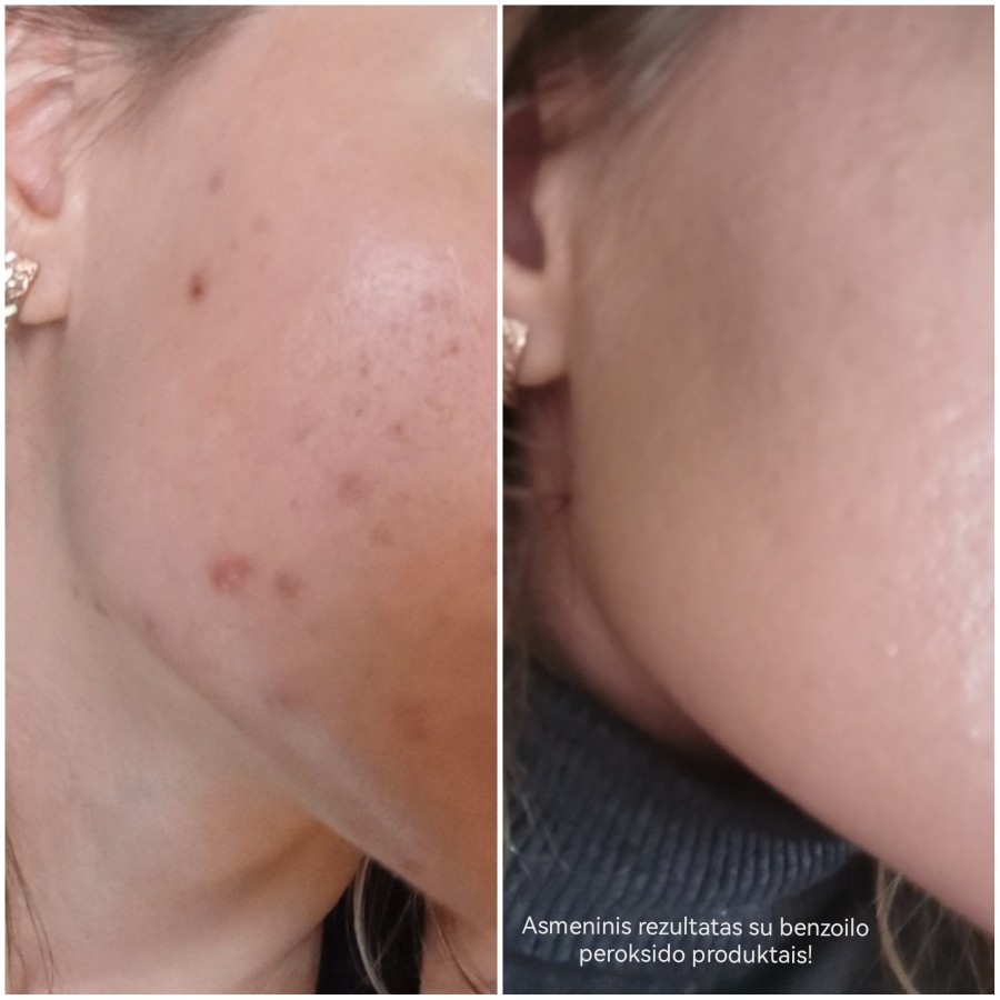 PanOxyl® putojantis prausiklis nuo aknės - benzoilo peroksidas 10 %